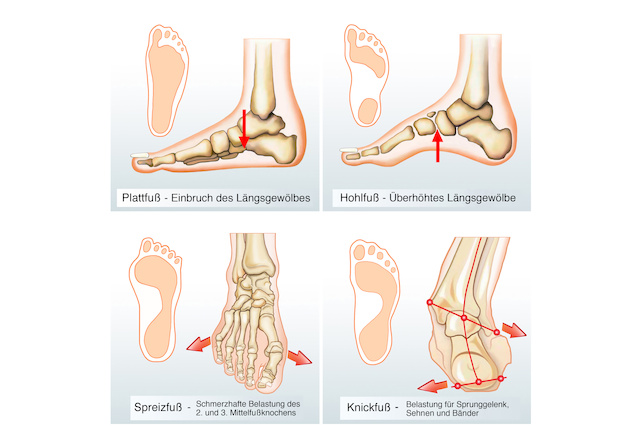 Fußfehstellung