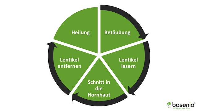 Augen laser, relex smile, ablauf, operation