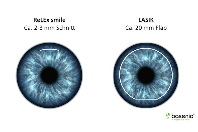 Augen lasern, Relex smile, Lasik, Schnittvergleich