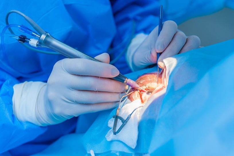 Femto-LASIK | iLASIK | Kosten | OP | Methode| Vergleich | Erfahrungen Bild zum Artikel: Femto-LASIK | iLASIK | Kosten | OP | Methode | Vergleich | Erfahrungen