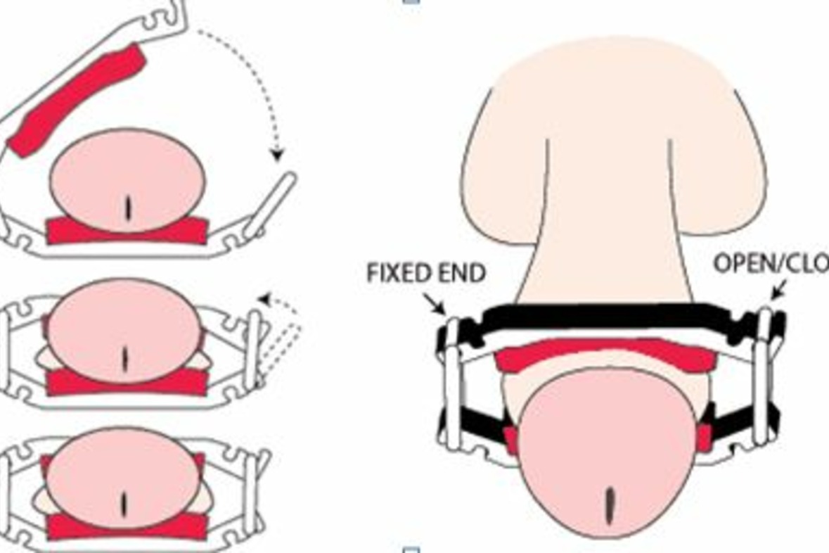 Dribblestop® Inkontinenzklemme