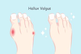 Schuhe bei Hallux valgus für Damen & Herren: Worauf kommt es an?