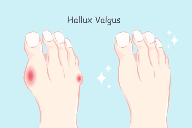 Hallux valgus | Schuhe | richtige | Damen | Herren | modisch