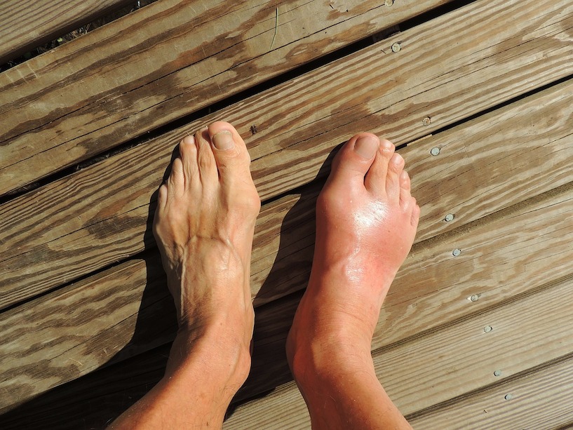 Gicht gilt als Volkskrankheit und kann das Laufen zur Qual werden lassen. Füße, Fuß, Sandalen, laufen, gehen, spazieren gehen, Gicht