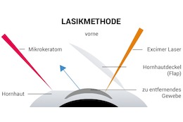 Alle Infos zum LASIK-OP-Verfahren – Methode, Risiken & Kosten im Überblick