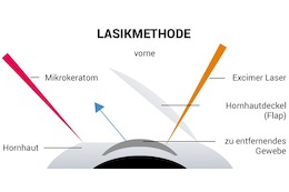 LASIK Augenlasern OP: Erfahrungen zur Methode sowie Risiken & Kosten im Überblick