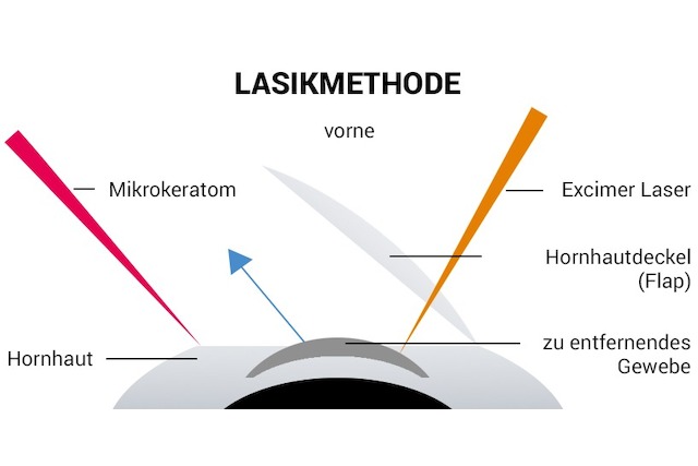 LASIK | Kosten | OP | Behandlung | Methoden | Risiken | Erfahrungen