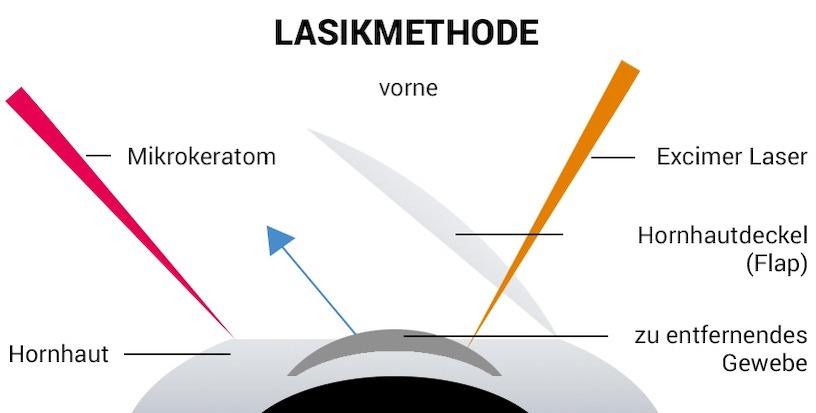 LASIK | Kosten | OP | Behandlung | Methoden | Risiken | Erfahrungen Bild zum Artikel: LASIK | Kosten | OP | Behandlung | Methoden | Risiken | Erfahrungen