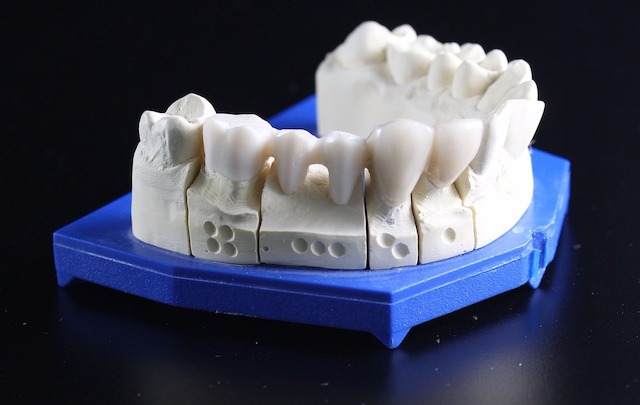 Zahnersatz, Zähne, Zahn